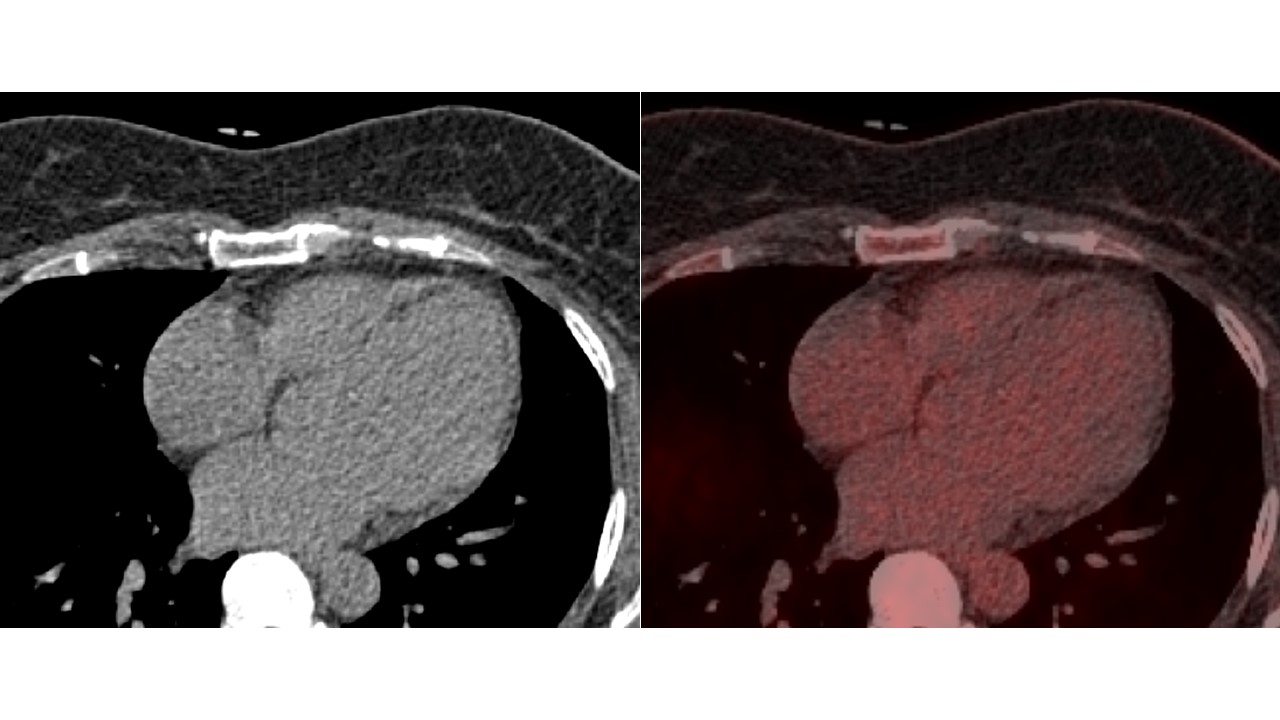 43/F, LV systolic dysfunction on echocardiography, history of VT