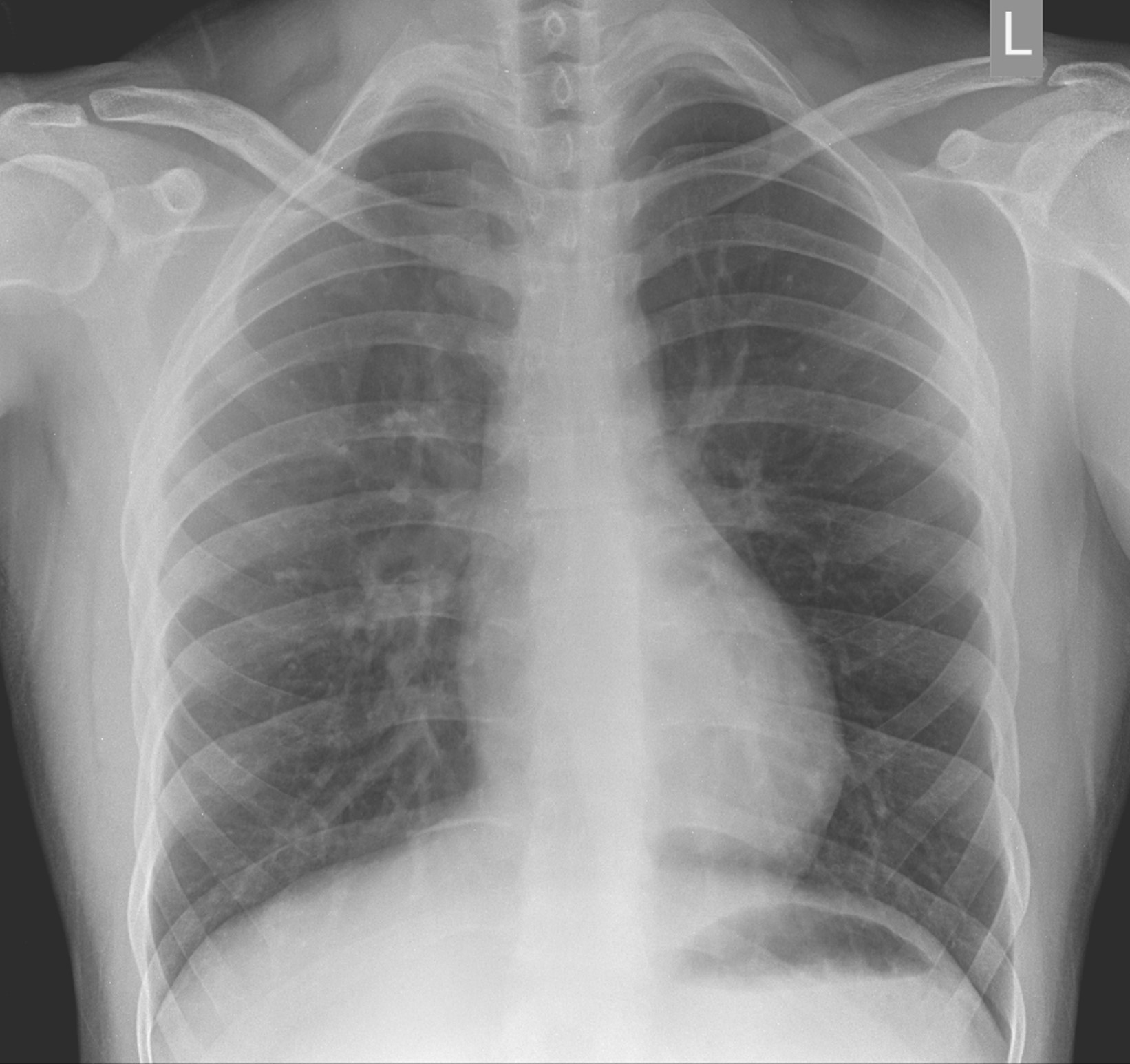 22/M, abnormality in echocardiography