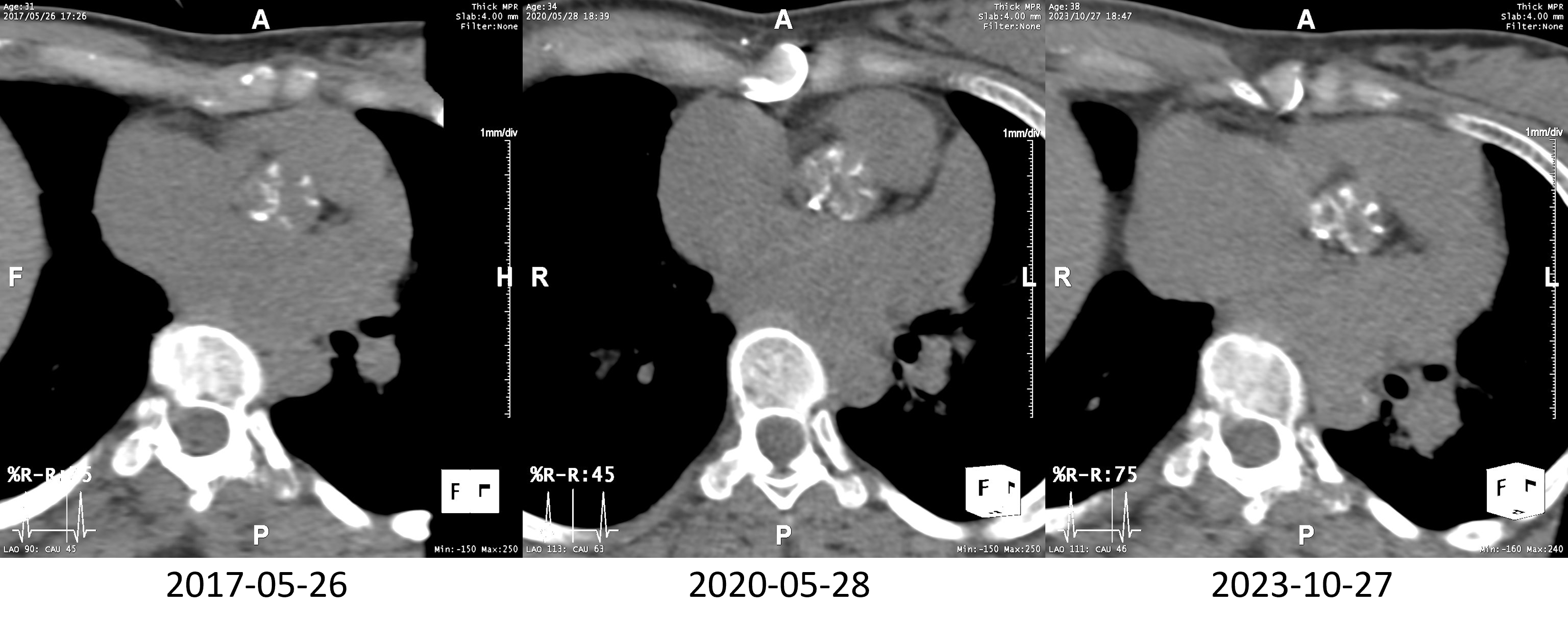 38/F, History: Aortic valve stenosis and mitral valve regurgitation S/P commissurotomy and decalcification of the aortic valve and mitral valve ring annuloplasty Intubation failure during surgery for a benign laryngeal tumor