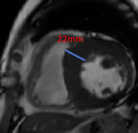 52/M, palpitations for three years, aggravated with syncope for over two months