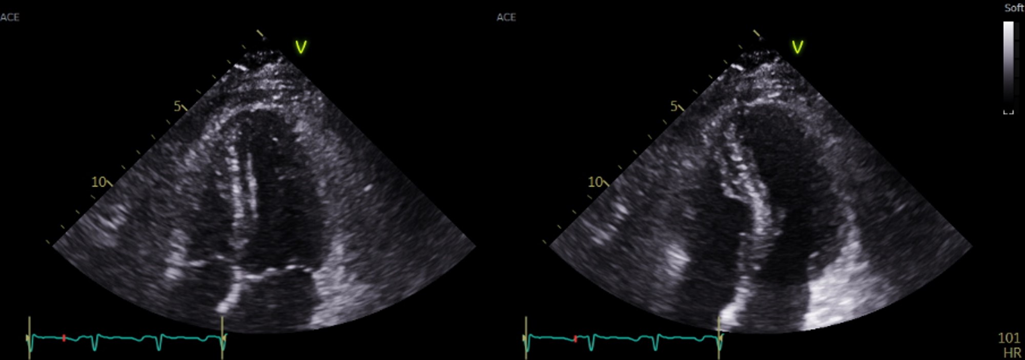 54/M, s/p Heart transplantation, 5 months ago  - s/p steroid therapy for acute cellular rejection Chief complaint: Exertional dyspnea