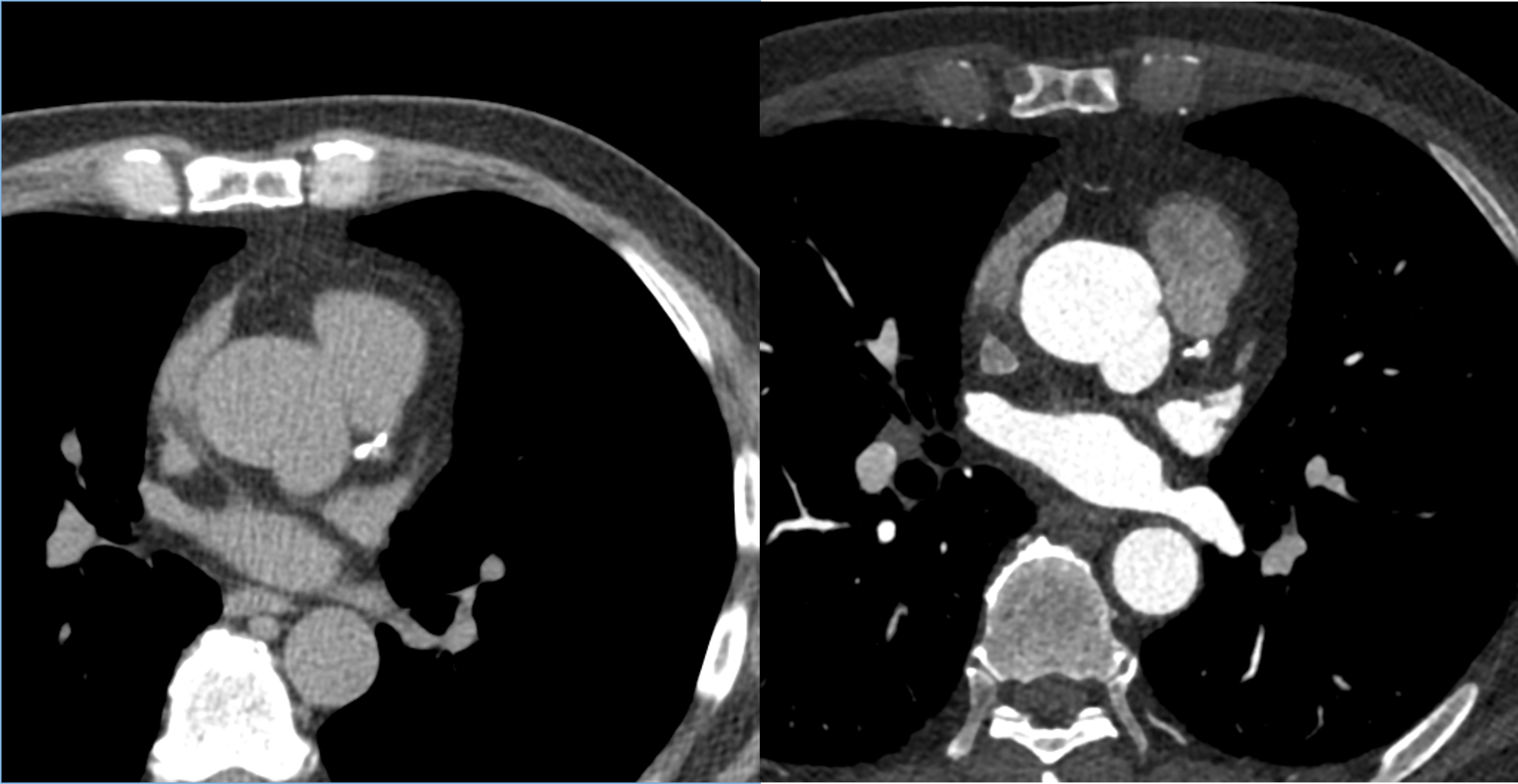 65/M, chest pain