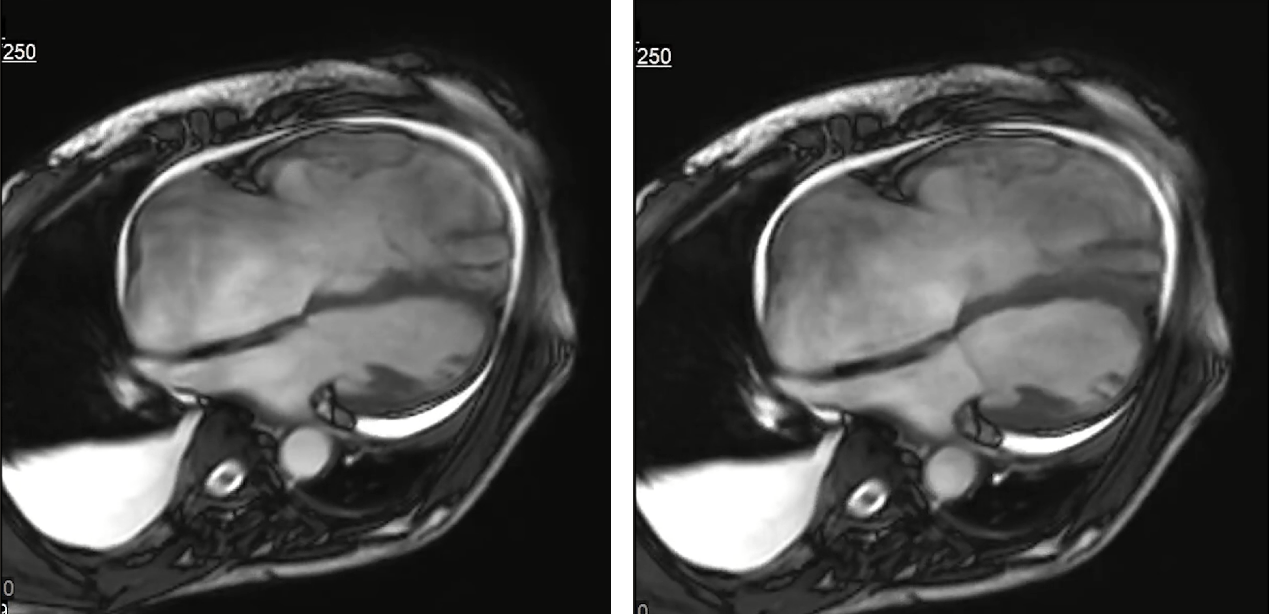 57/F, dyspnea, edema 1 month ago