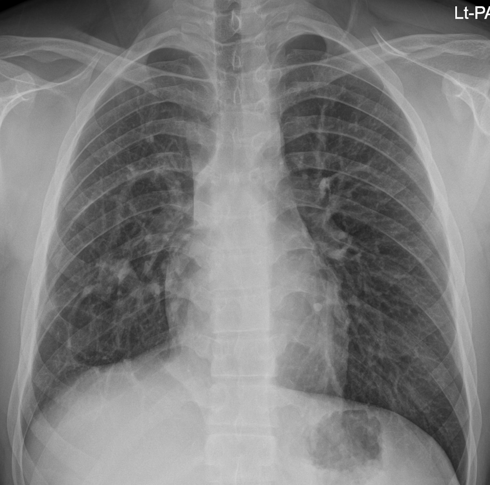 16/M, chest radiograph abnormality