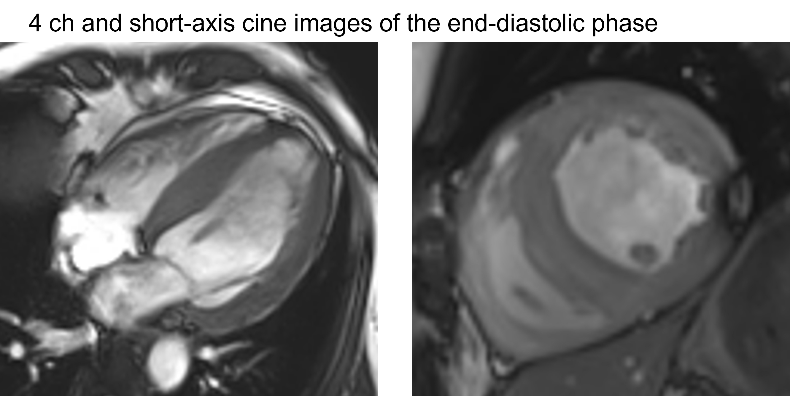 60/M, LVH in echocardiography, s/p pancreas and kidney transplantation due to type 1 DM and ESRD, hearing loss