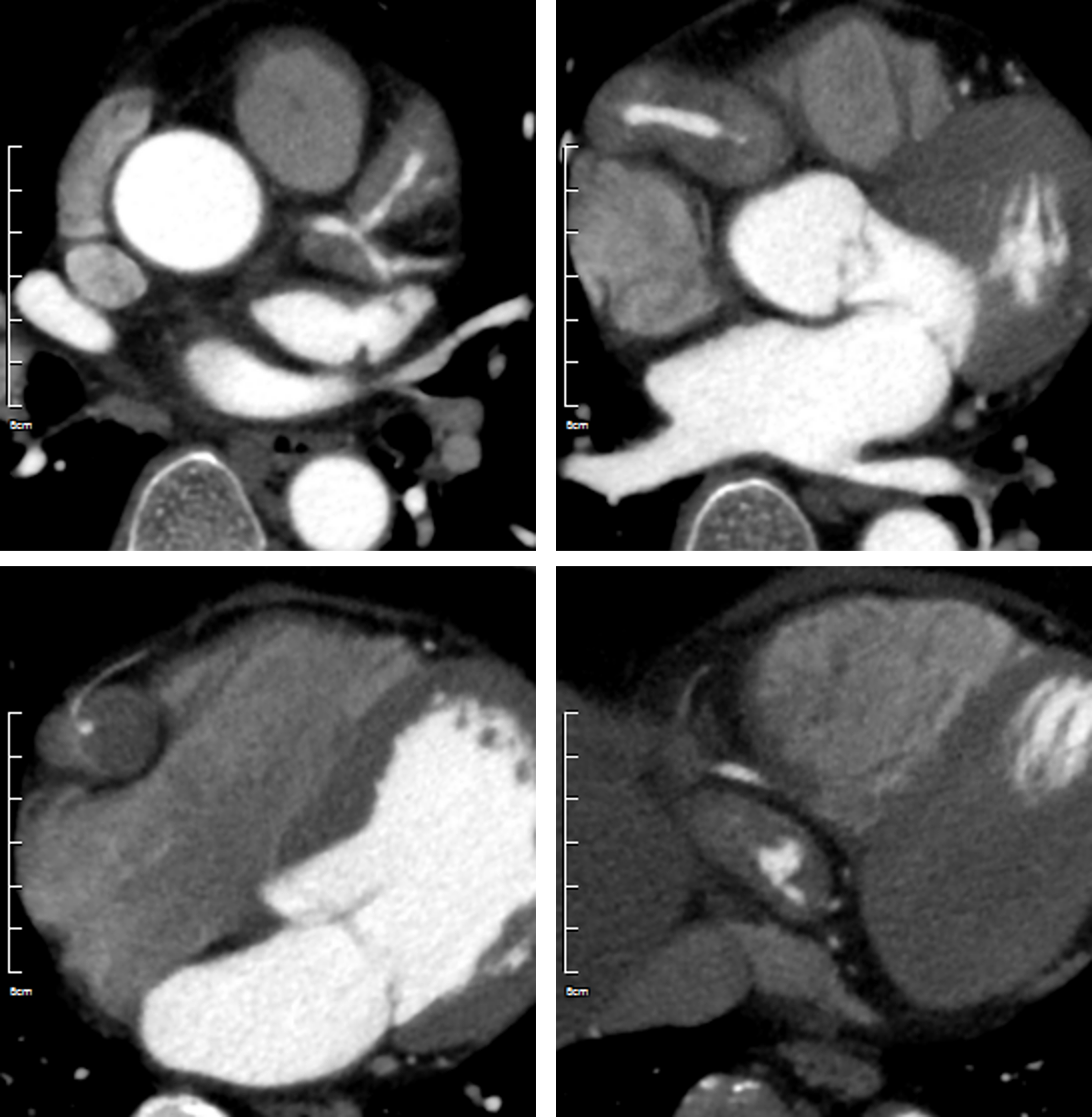 62/M, abnormal finding on coronary angiography 2days from PCI for distal RCA total occlusion