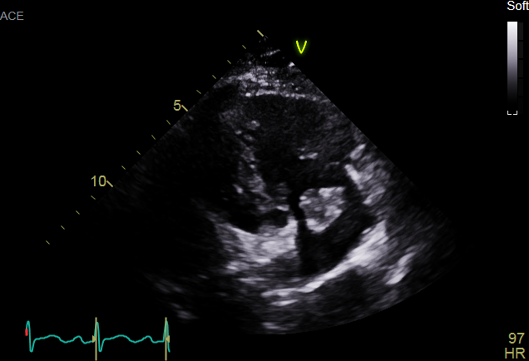 46/F, incidentally detected cardiac mass,  PHx. : history of lymphoma