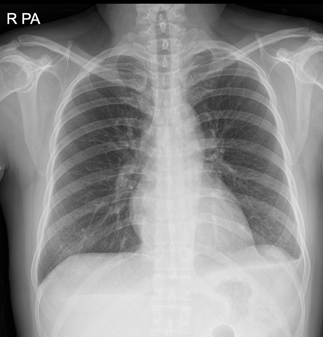 40/F, fever and right neck pain, on chemotherapy for breast cancer