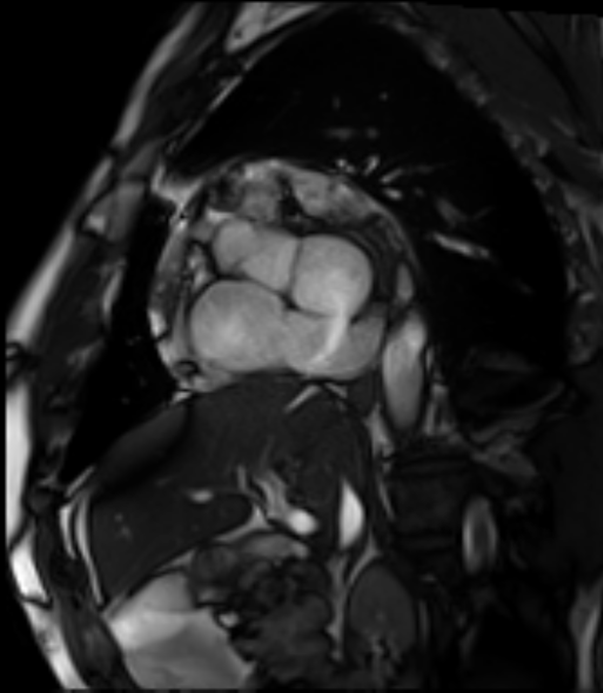 Unroofed coronary sinus