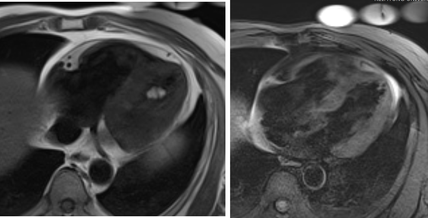 50/M, Incidental intraventricular mass
