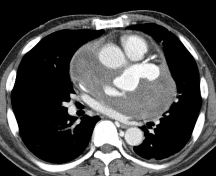 54/M, chest pain - Giant coronary artery aneurysm after sarcoidosis