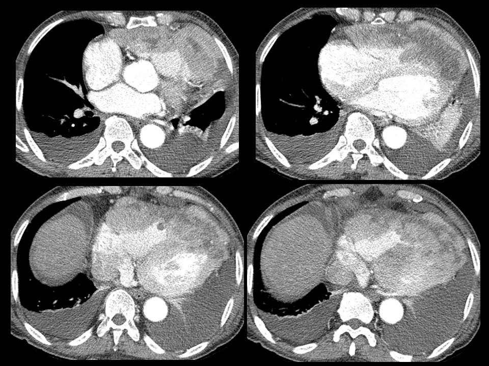 74/M, aggravation dyspnea (1 weak ago)