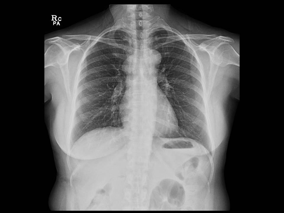 48/M, incidental image finding, history of pulmonary TB