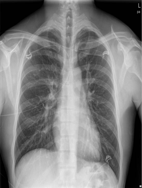 29/M, Chest pain (onset : 1 week ago)