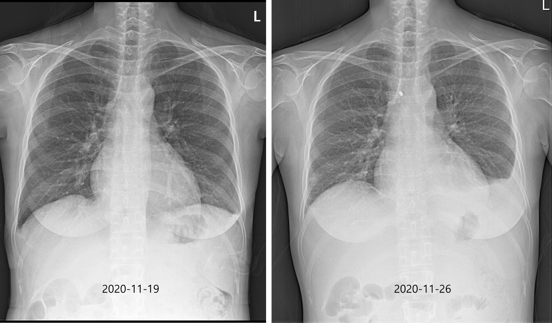 Spontaneous bleeding of the internal mammary artery in a patient with alcoholic liver cirrhosis