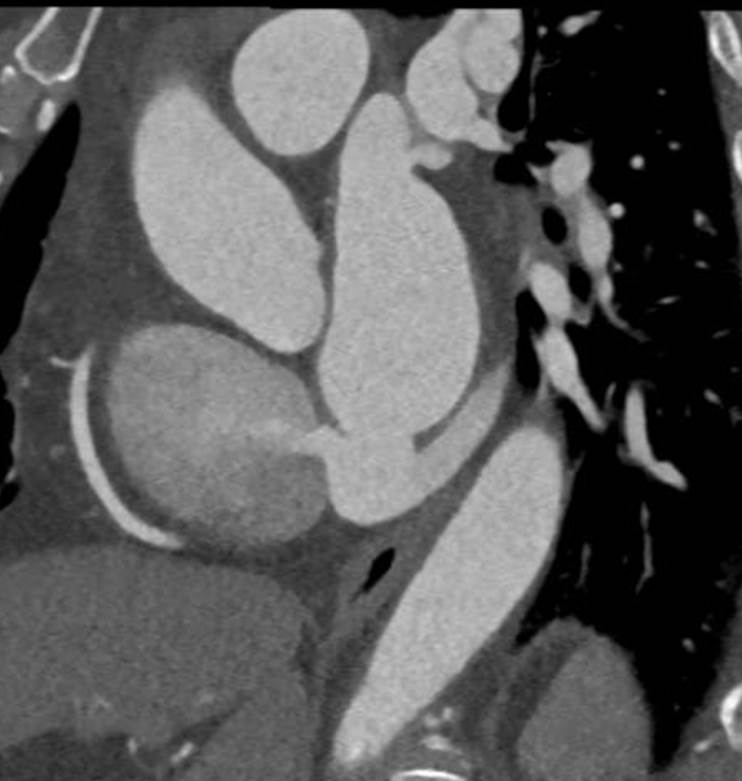 F/57, Incidentally found radiologic abnormality