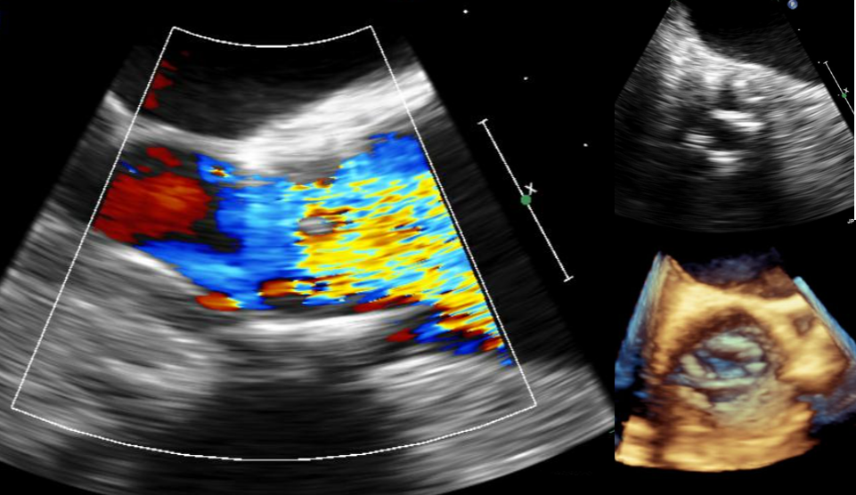 72/F, chest pain and dyspnea