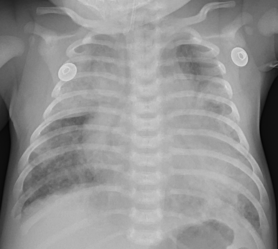 4W/F, dyspnea, cyanosis