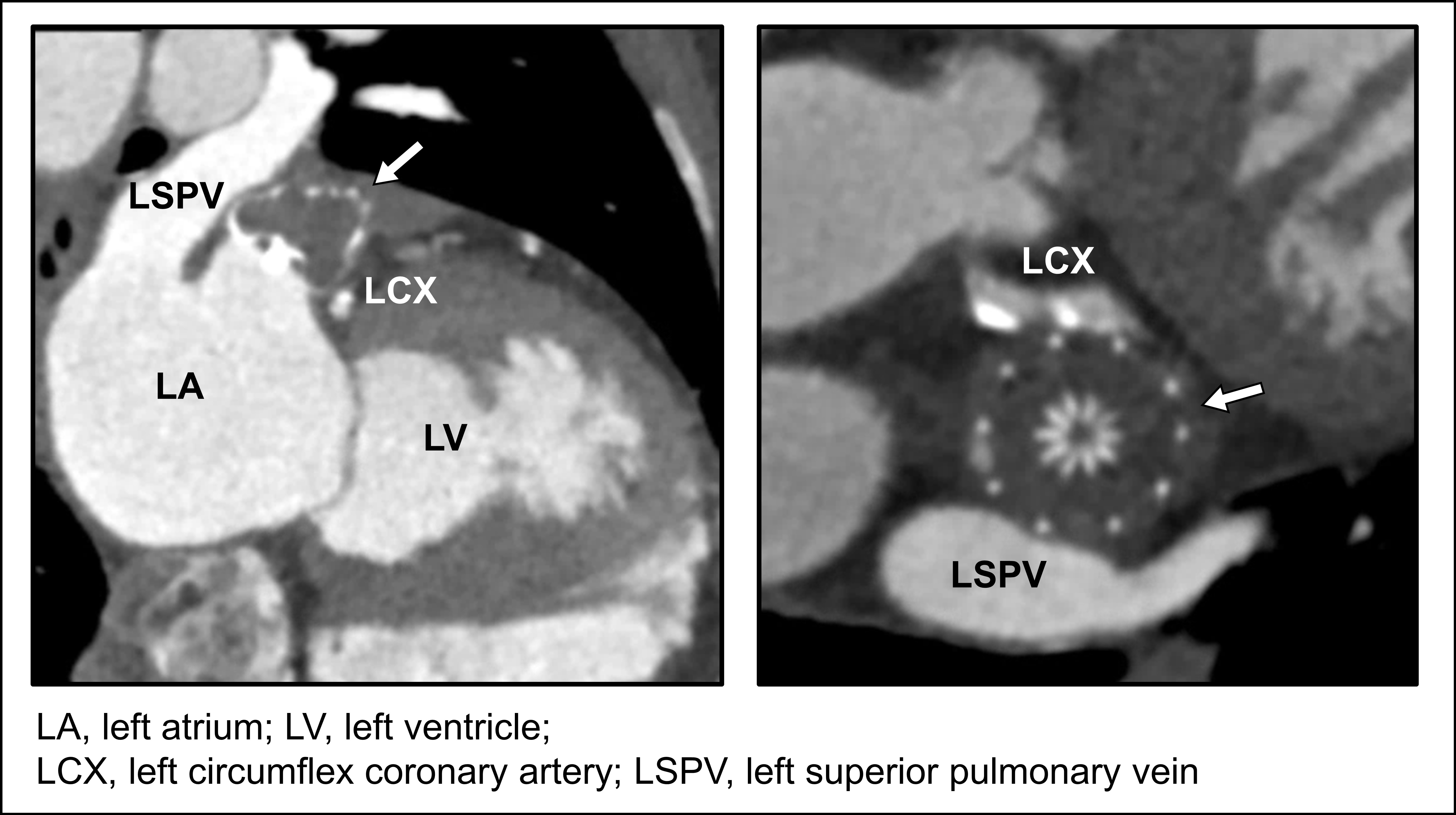Post left atrial appendage occlusion status 