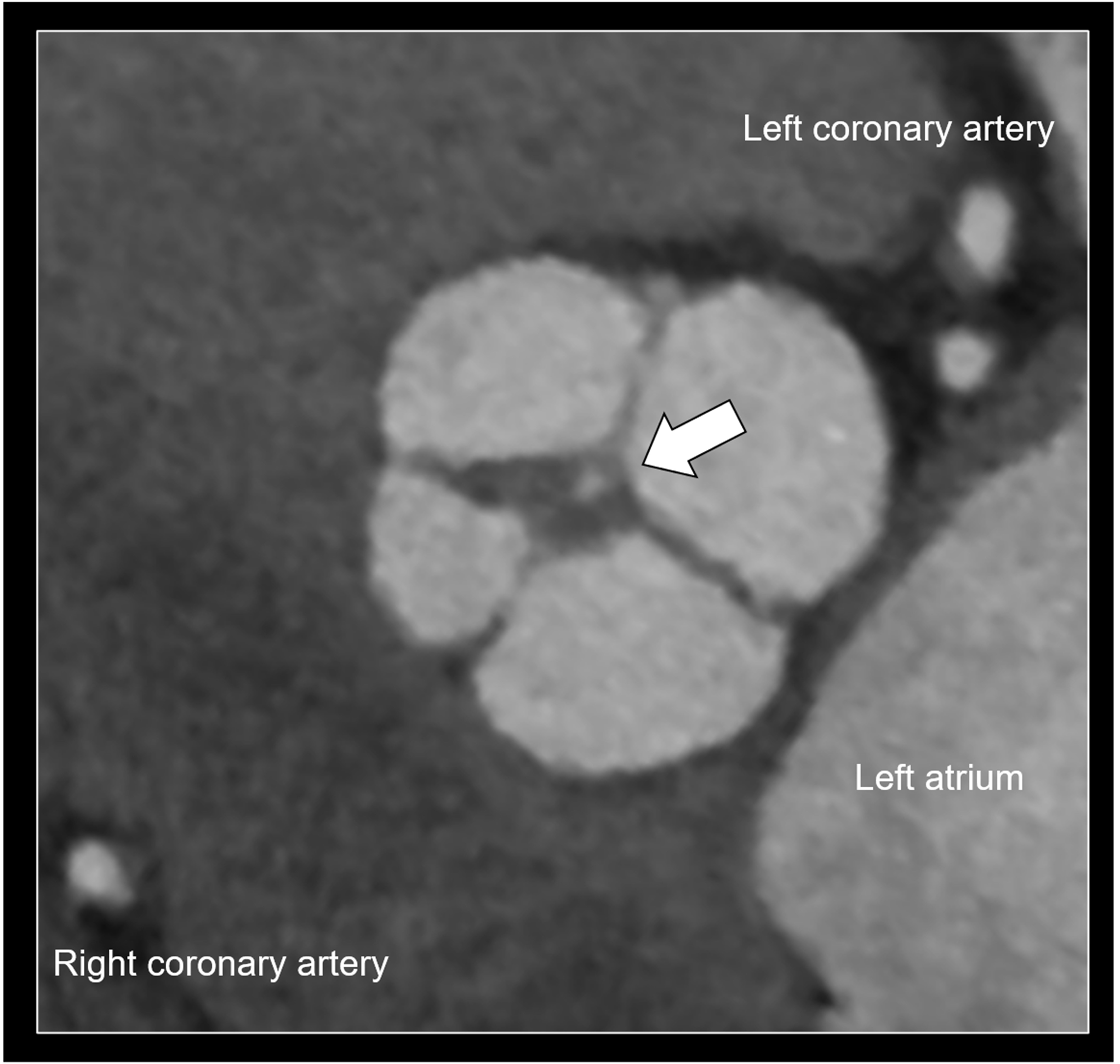 Quadricuspid aortic valve