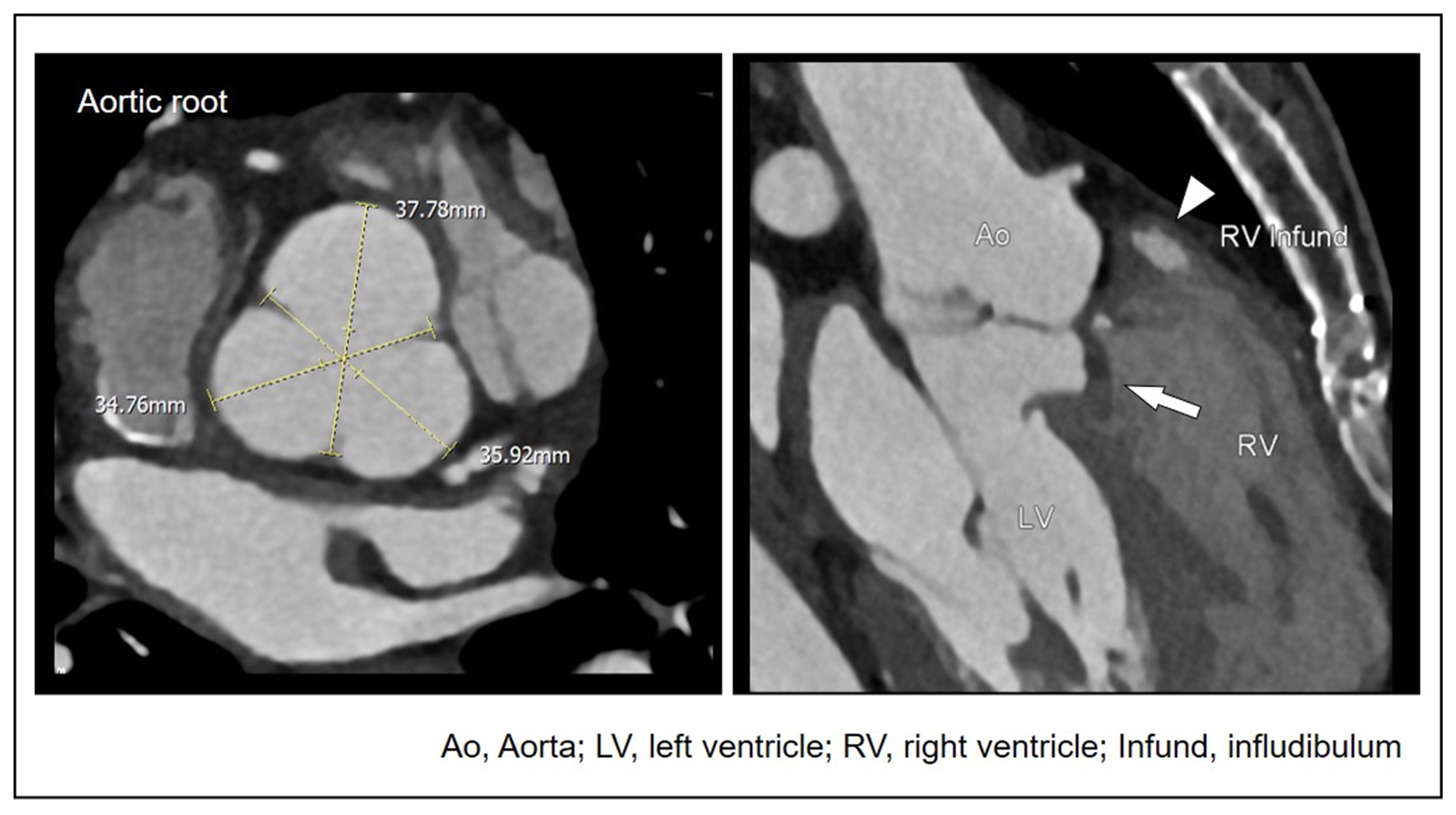 Aortic root dilatation after TOF repair