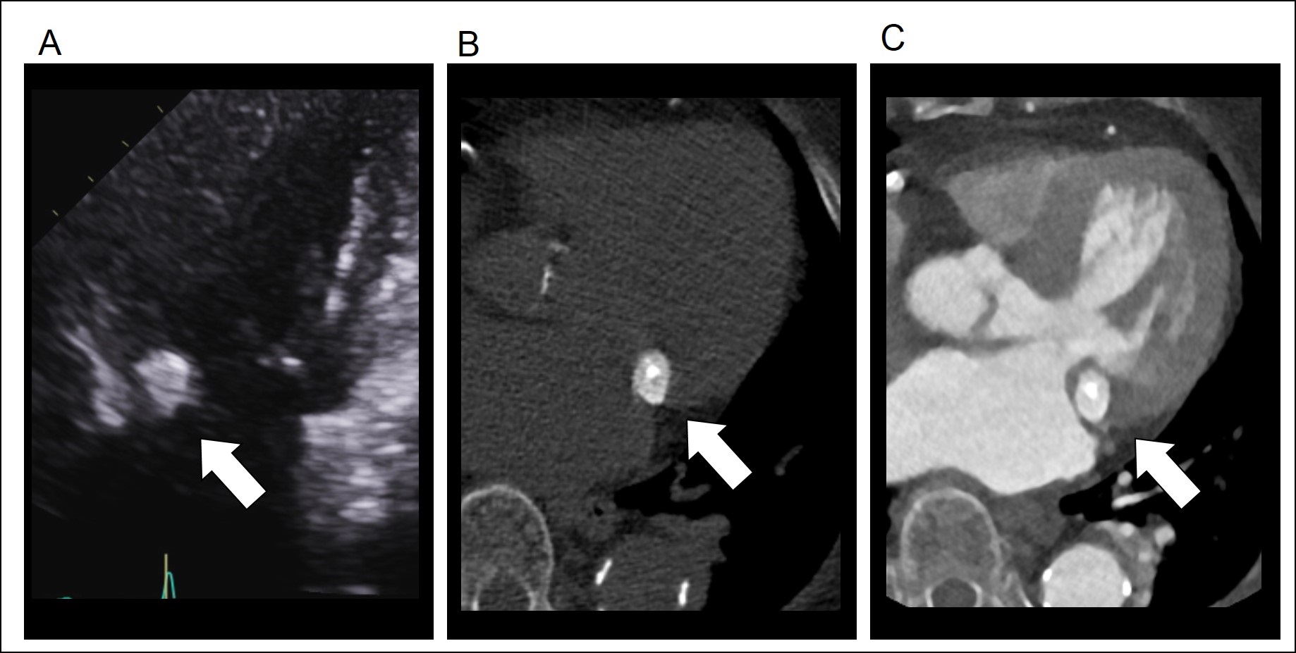 88/F, incidentally noted cardiac mass
