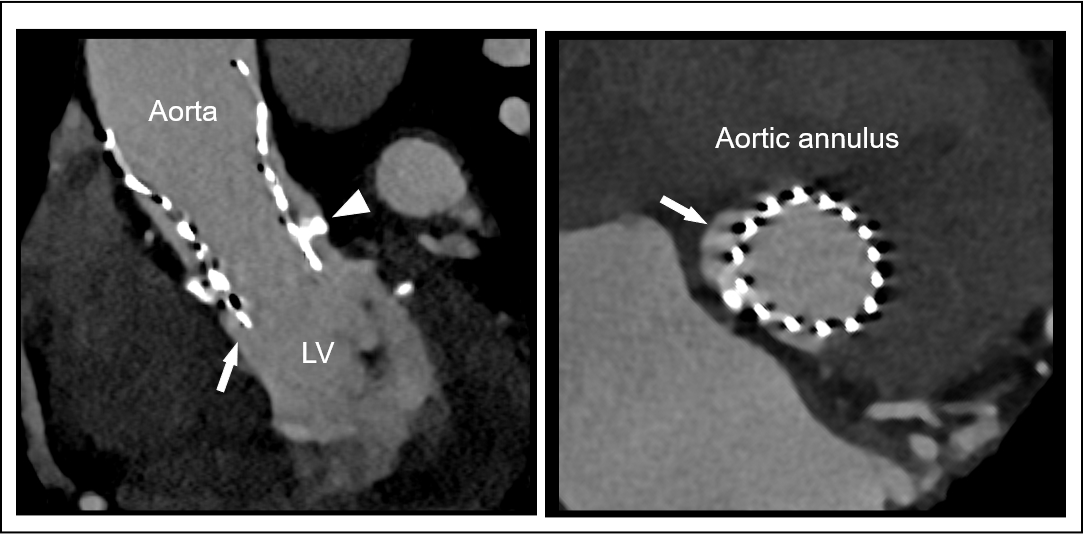 Paravalvular leak in TAVR 