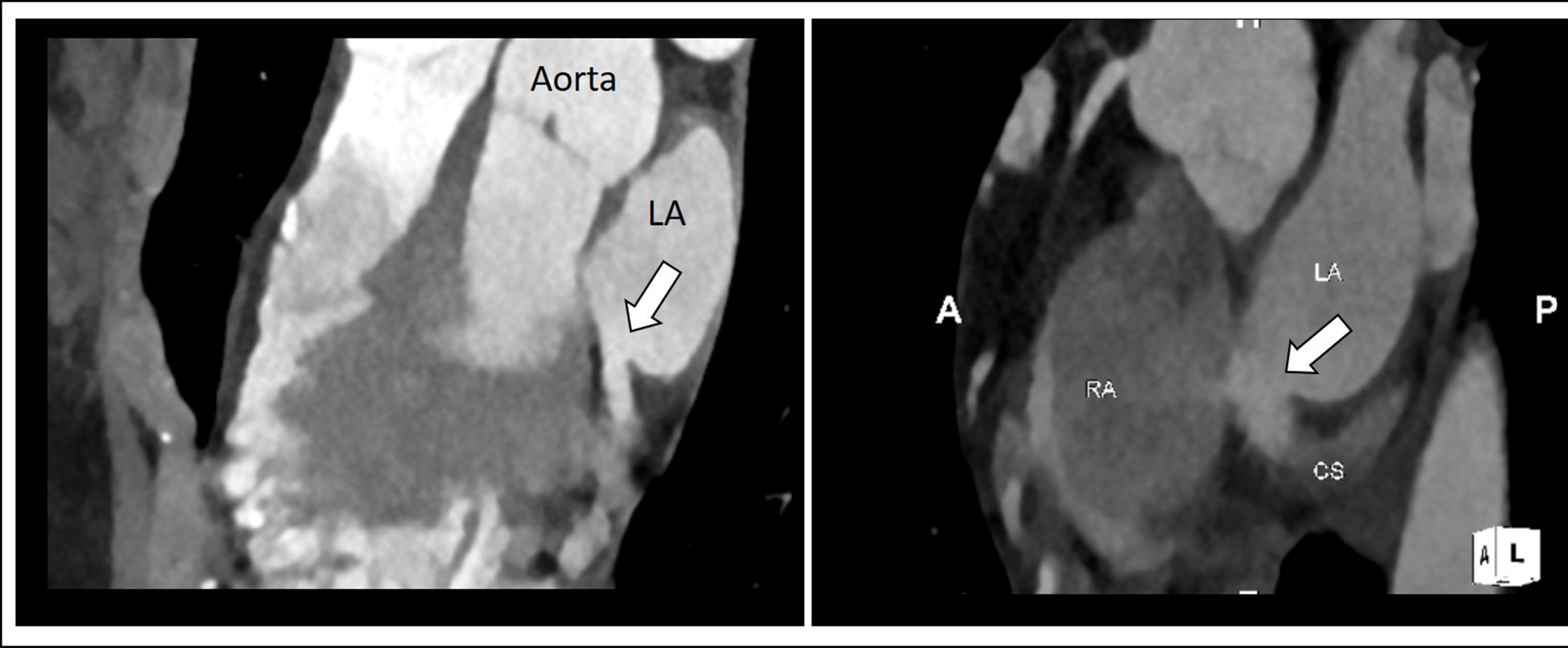 Unroofed coronary sinus 