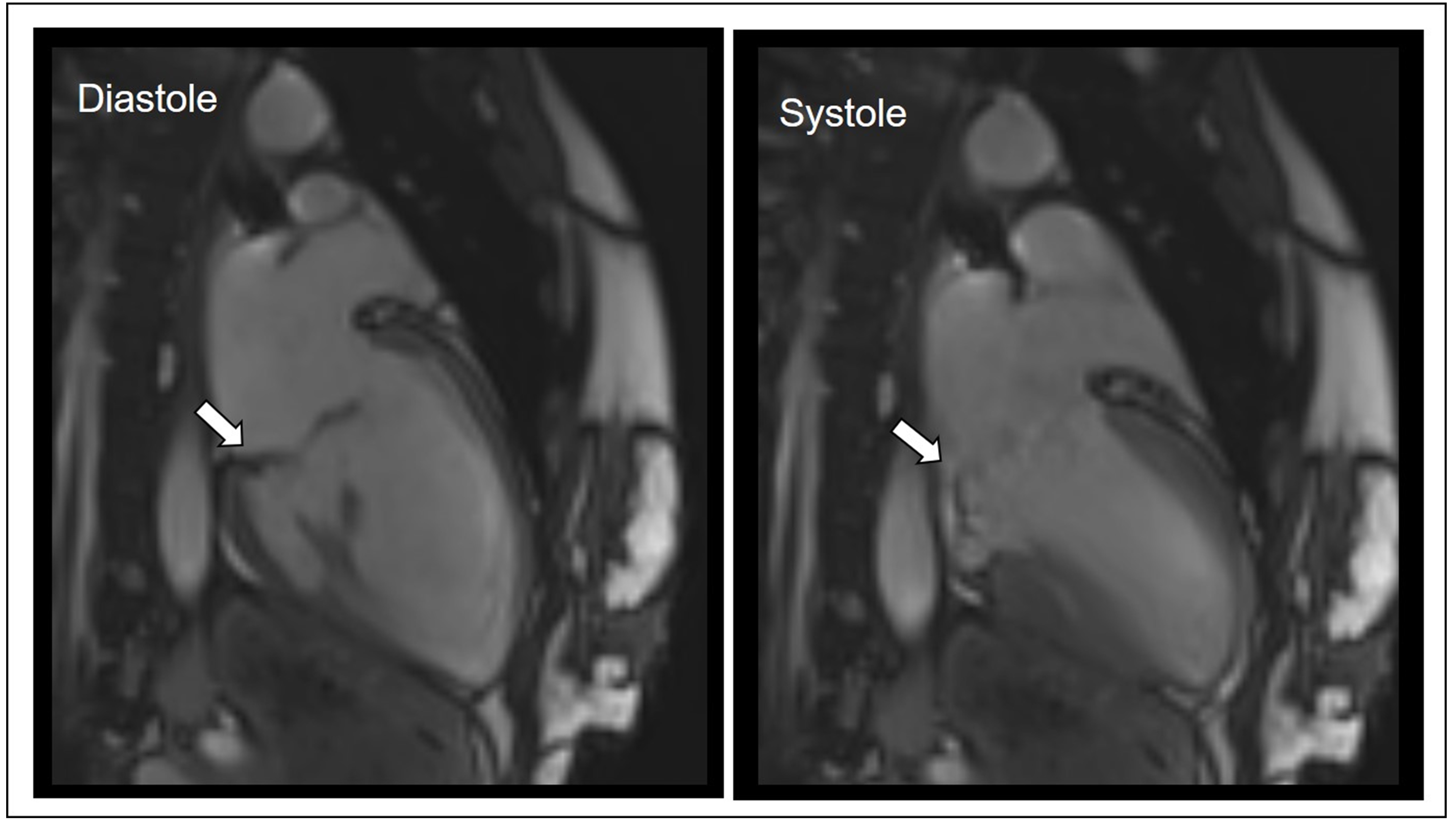 Mitral Valve Prolapse