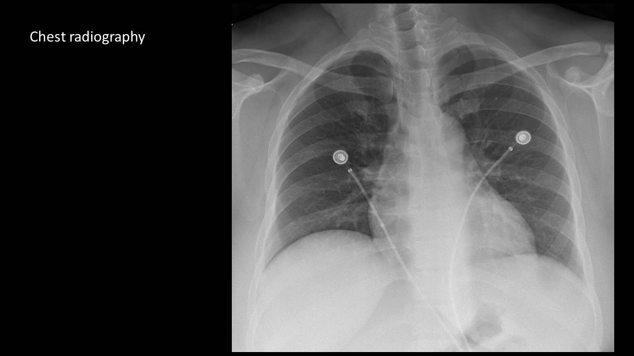 36/F, chest pain