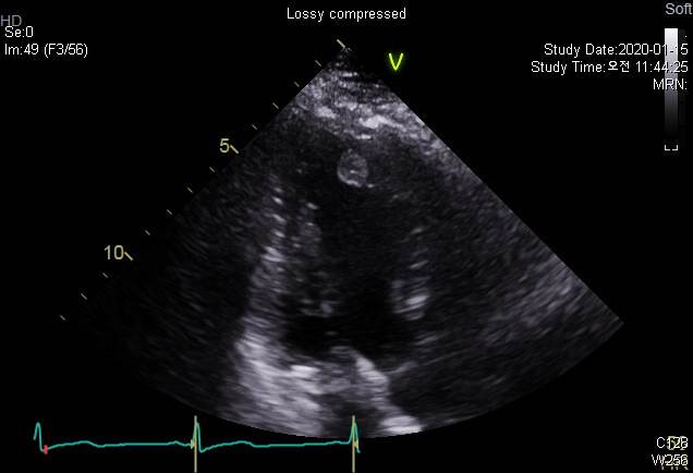 60/F, incidentally detected LV mass