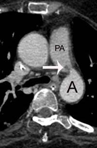 CT Diagnosis of patent ductus arteriosus endarteritis