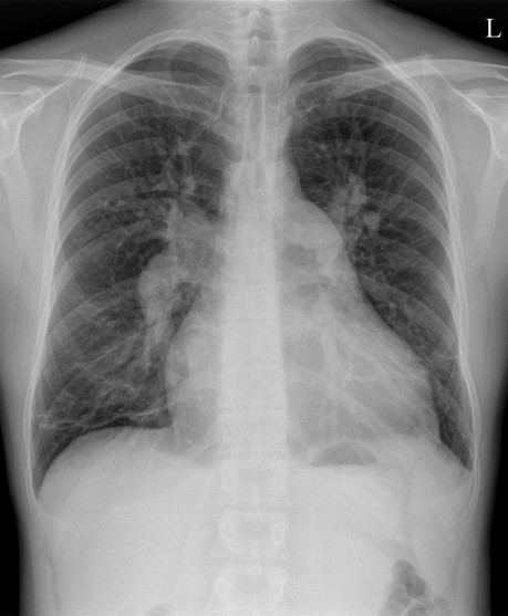 Atrial septal defect