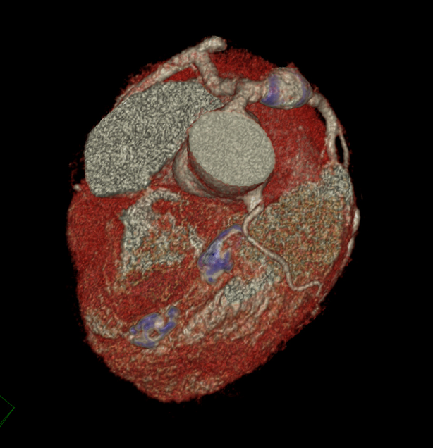 Kawasaki disease