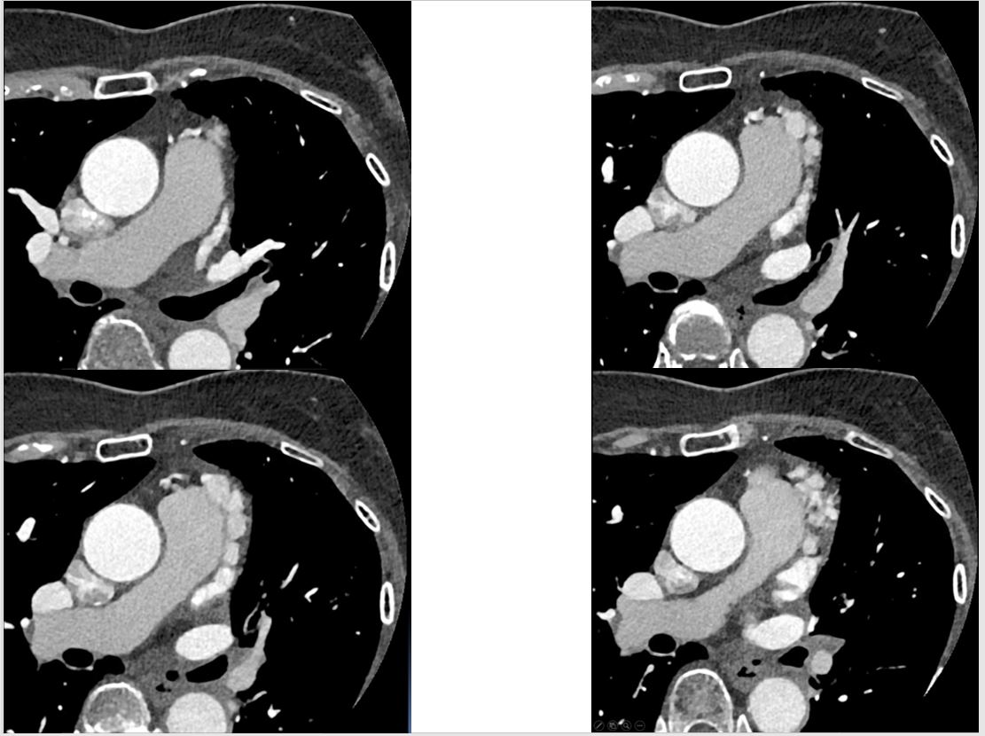 57/M, coronary artery fistula