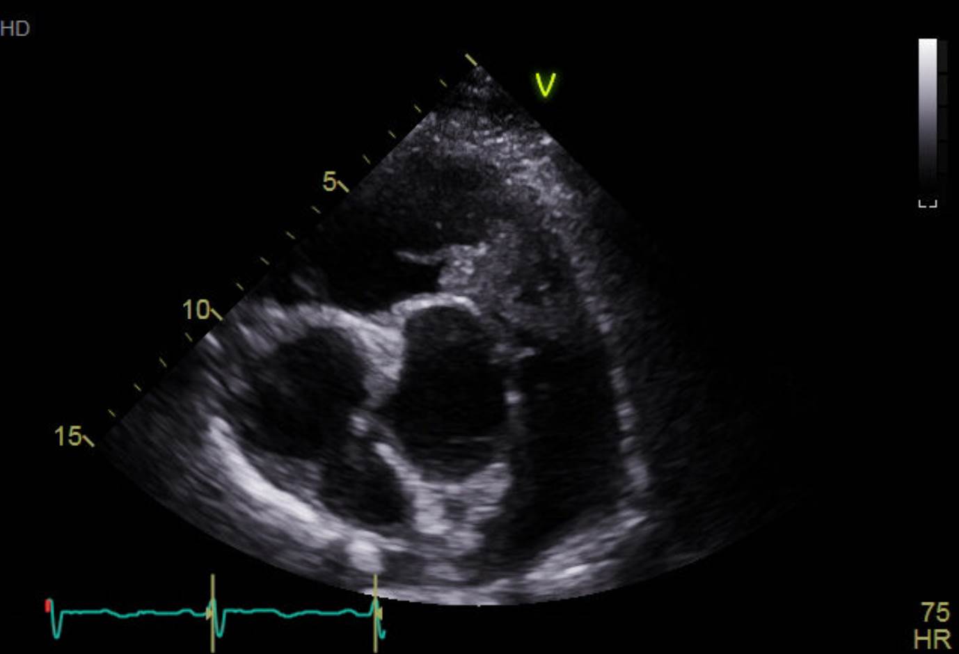 81/M, dyspnea, PHx. Left leg amputation due to leiomyosarcoma (4 years ago)