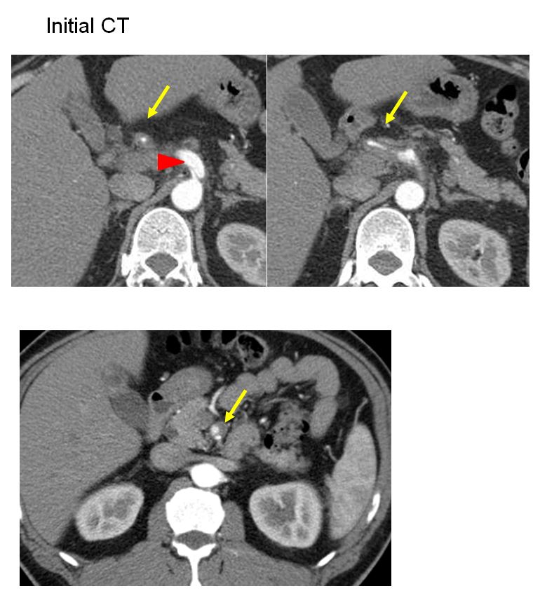 49/F, abdominal pain (5HA)