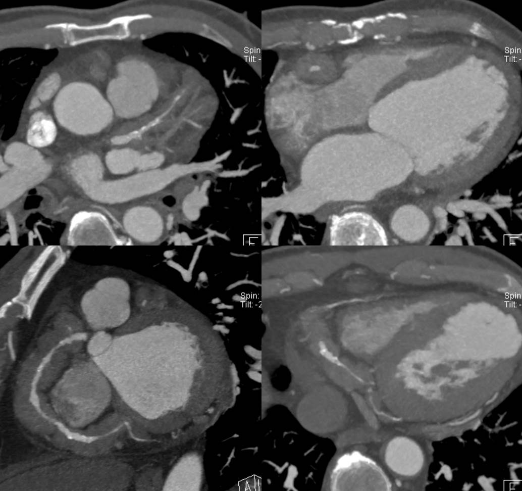 57/M, chest pain