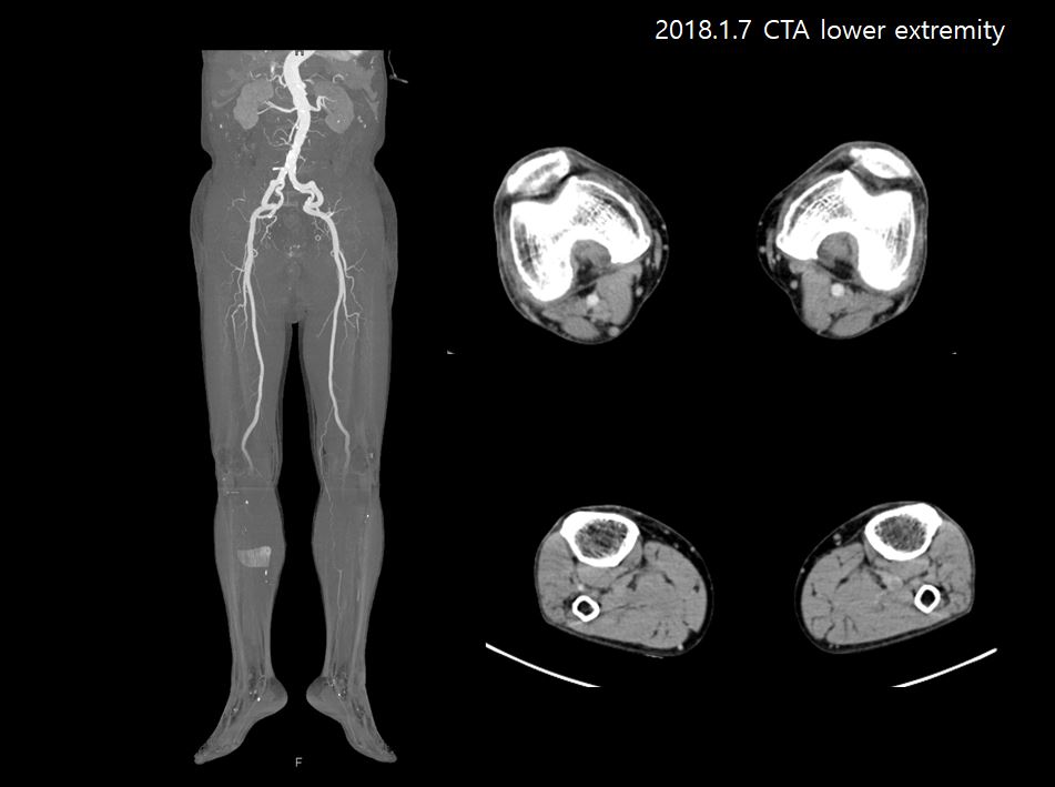 71/M, pain and numbness of right lower limb