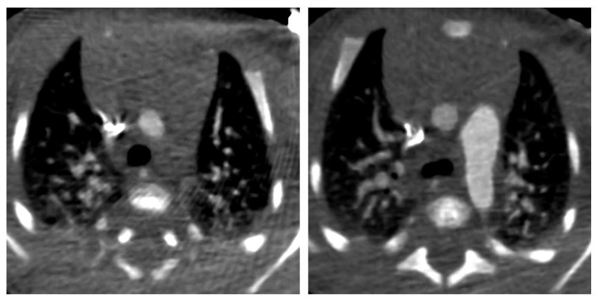 11/F, cardiomegaly on x-ray