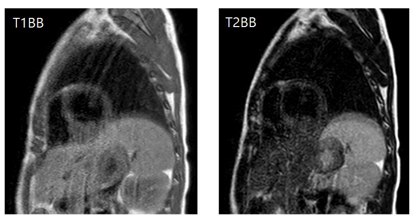 3/F, incidental finding on echocardiography, delayed development