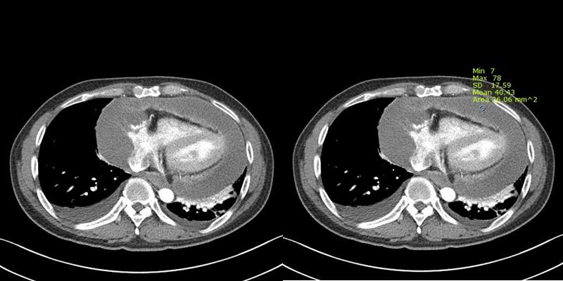 34/M, chest discomfort