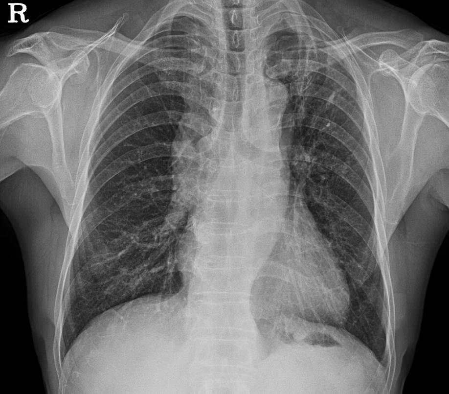 73/M,  dyspnea (MRC grade 1)