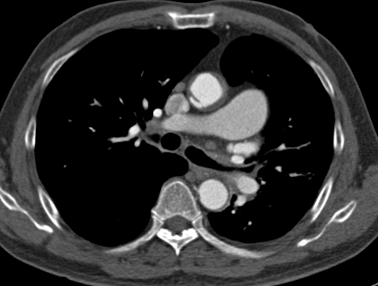 79/M, incidental findings on pre-operative CT