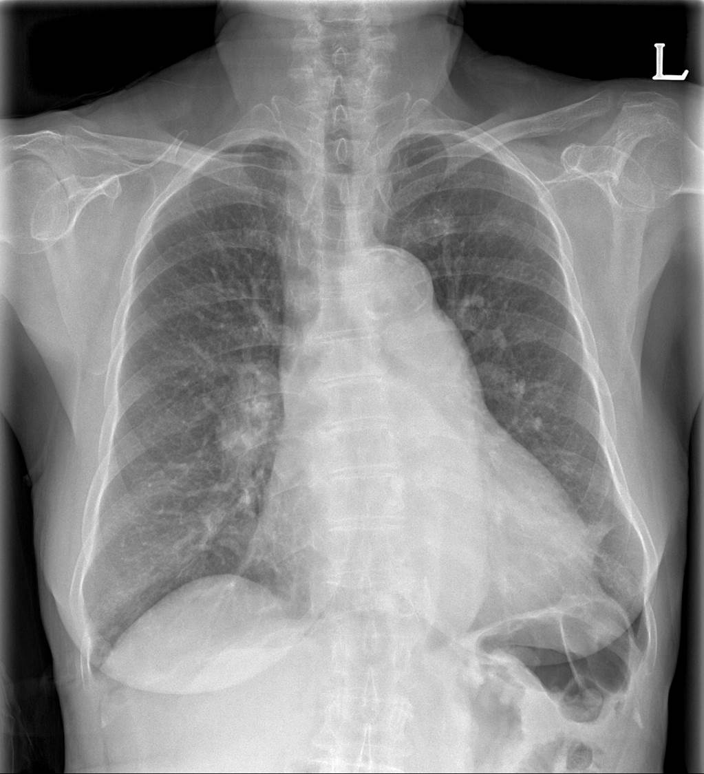 79/F, dyspnea