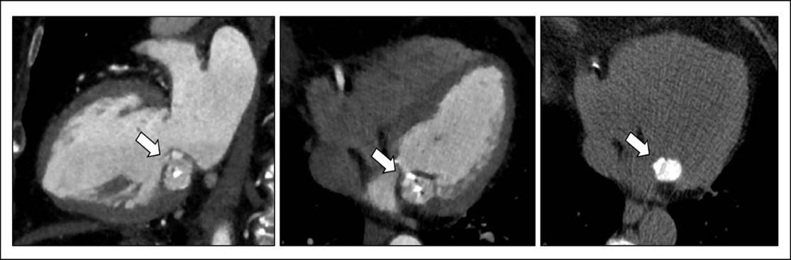 74/F, chest discomfort, mitral annular caseous calcification