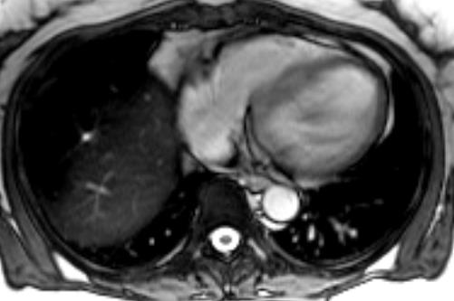 56/F, insidiously onset dyspnea and chest discomfort