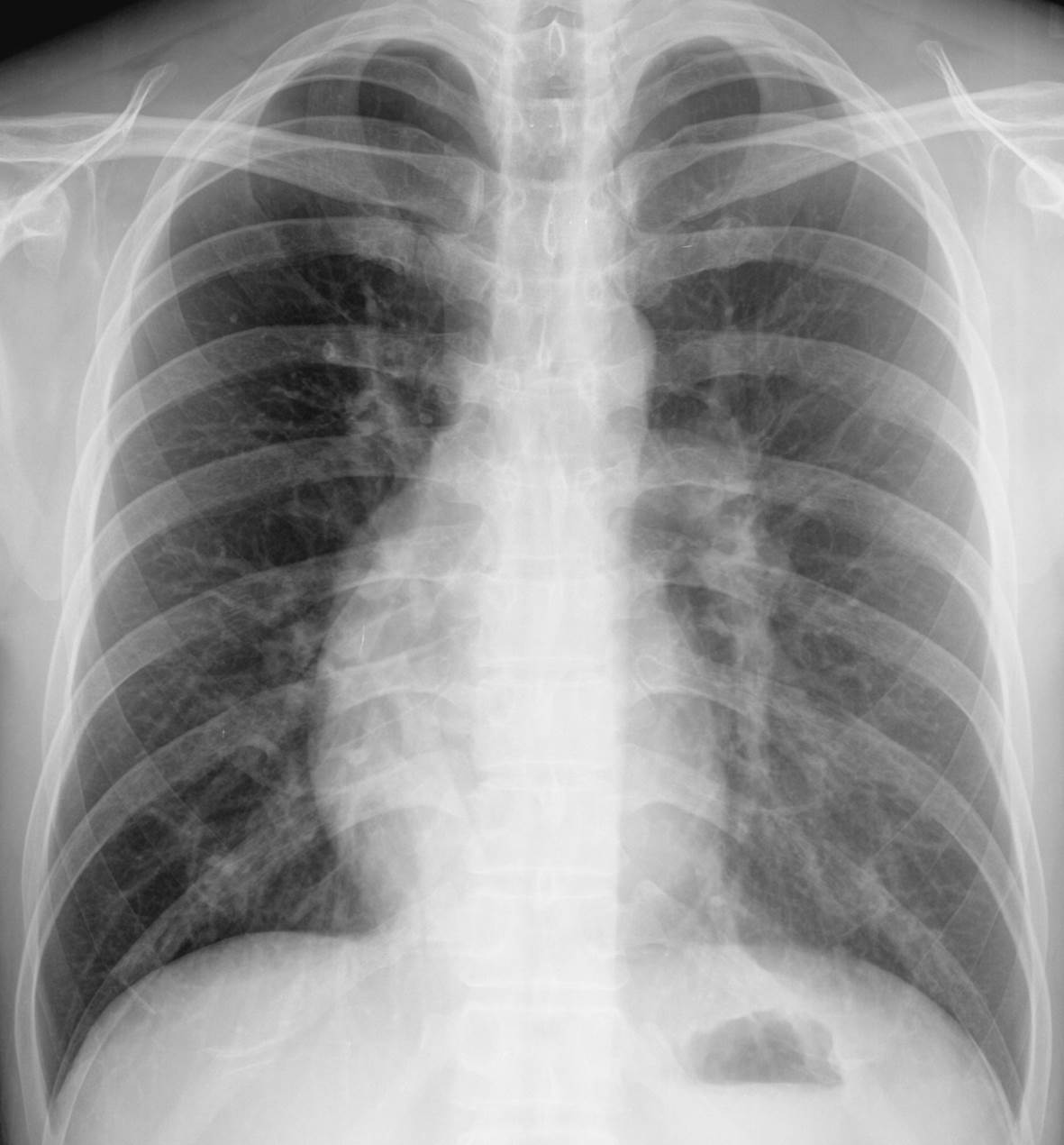 32/M, right chest pain (2MA)