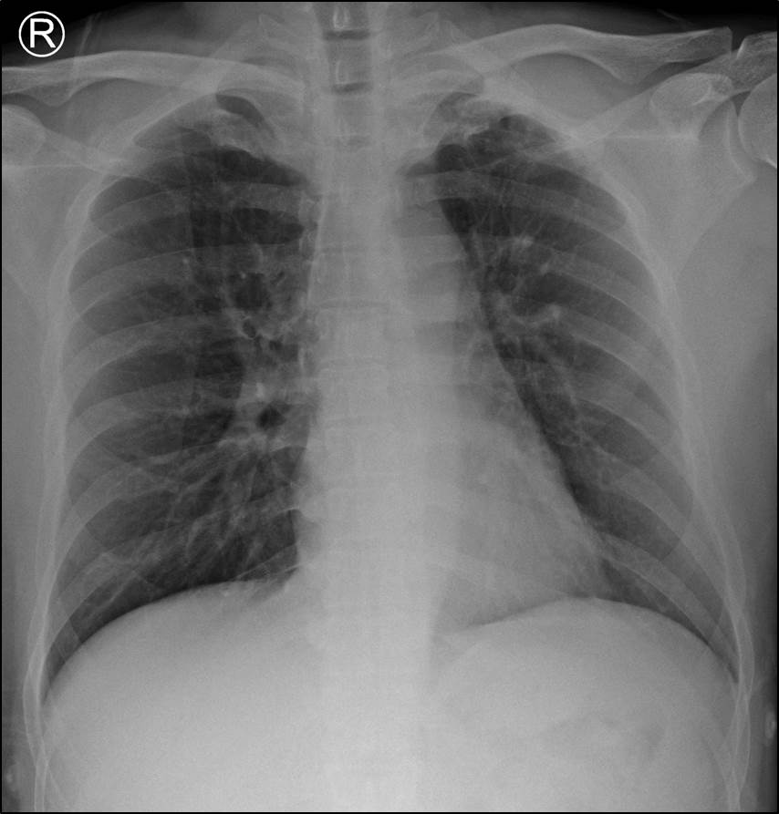 41/M, acute chest pain at substernal area
