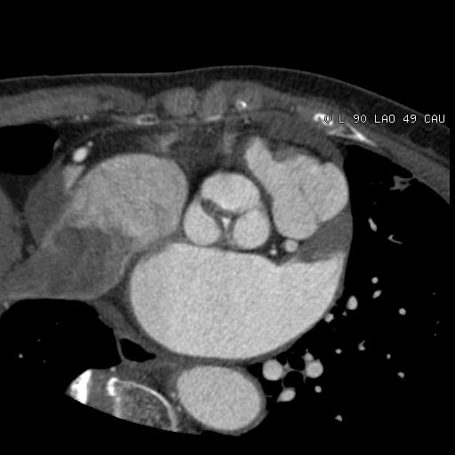 66/F, visual field defect